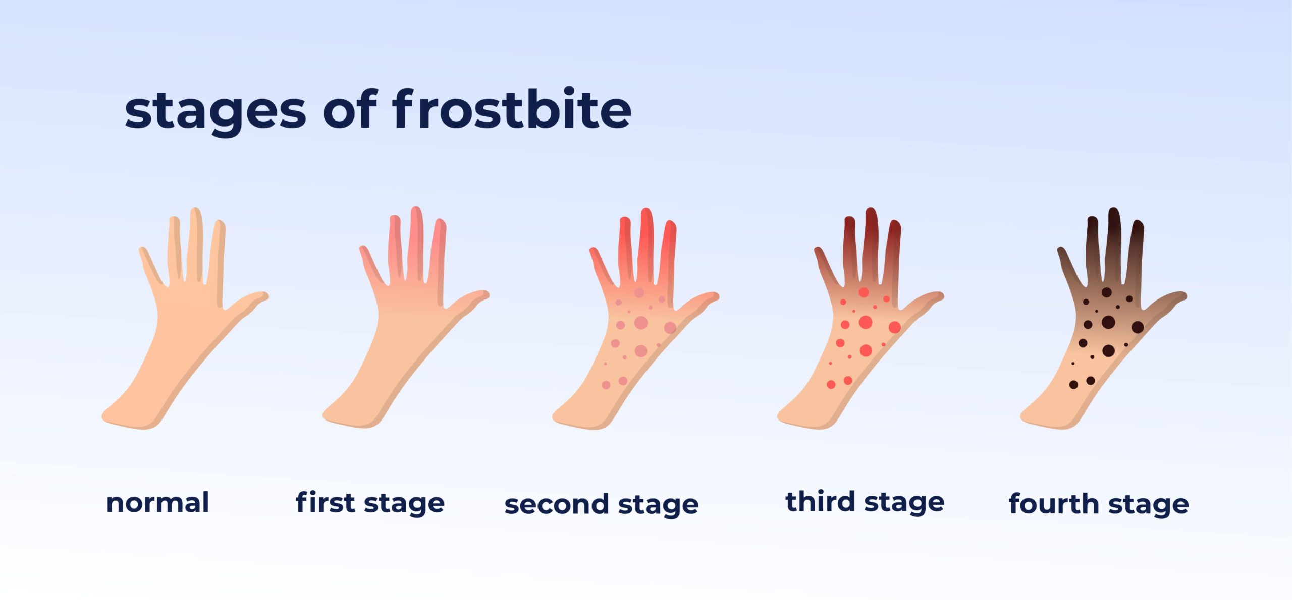 The 5 stages of frostbite