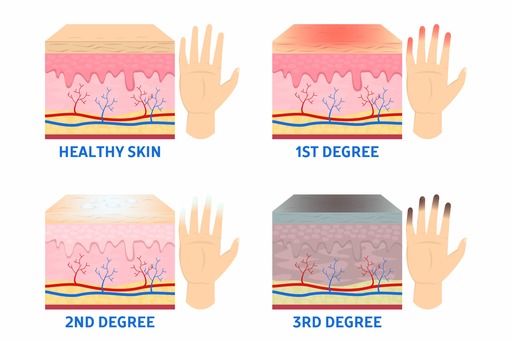 The 4 stages of frostbite